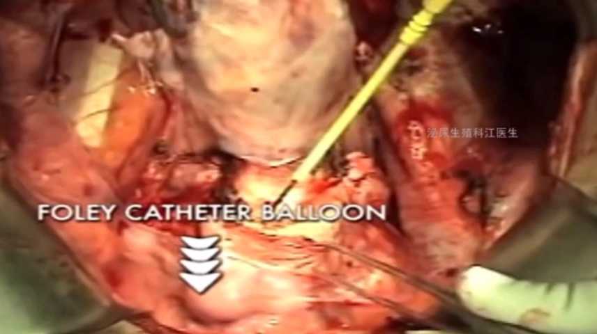 《猎奇》重口，进入慎重肚子破开，割除子宫（2）-变态